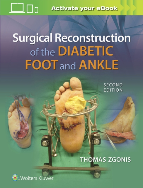 Surgical Reconstruction of the Diabetic Foot and Ankle, Hardback Book