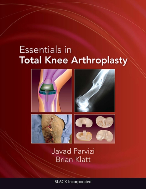 Essentials in Total Knee Arthroplasty, Hardback Book