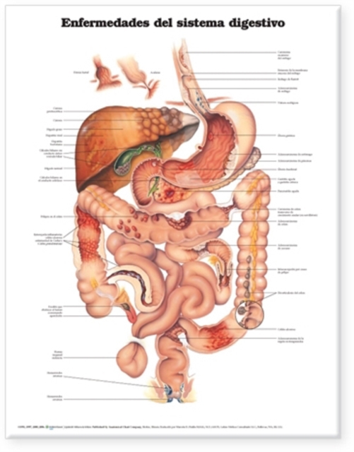 Diseases of the Digestive System Anatomical Chart in Spanish (Enfermedades del Sistema Digestivo), Wallchart Book