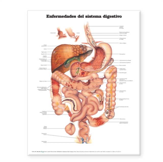 Diseases of the Digestive System Anatomical Chart in Spanish (Enfermedades del Sistema Digestivo), Wallchart Book