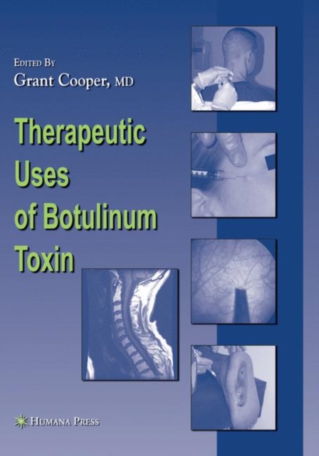 Therapeutic Uses of Botulinum Toxin, Hardback Book