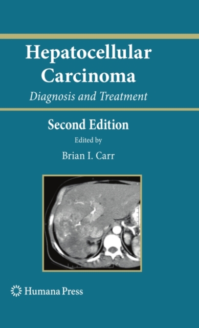 Hepatocellular Carcinoma : Diagnosis and Treatment, PDF eBook