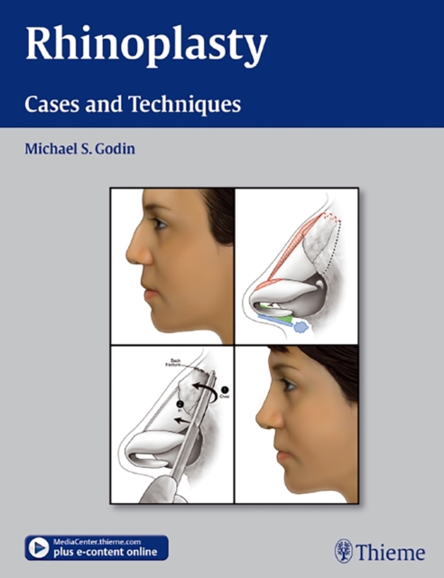 Rhinoplasty : Cases and Techniques, Hardback Book