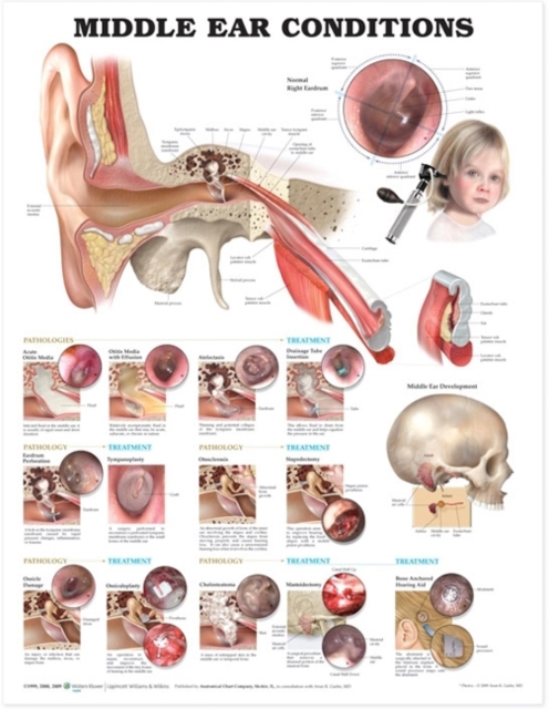 Middle Ear Conditions Anatomical Chart, Wallchart Book