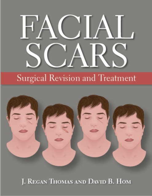 Facial Scars : Surgical Revision and Treatment, EPUB eBook