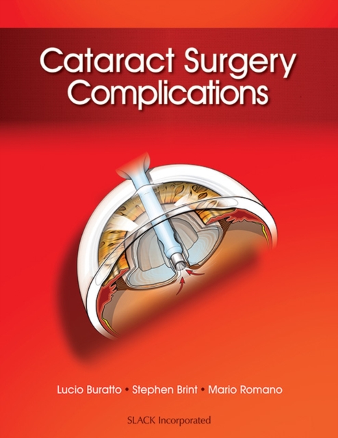 Cataract Surgery Complications, Hardback Book