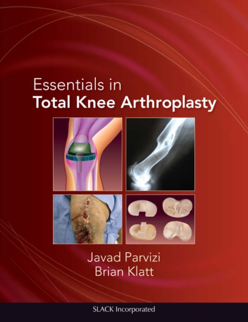 Essentials in Total Knee Arthroplasty, PDF eBook