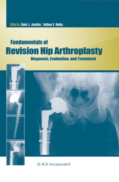 Fundamentals of Revision Hip Arthroplasty : Diagnosis, Evaluation, and Treatment, EPUB eBook