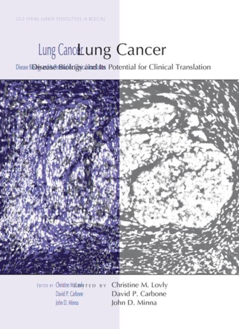 Lung Cancer : Disease Biology and Its Potential for Clinical Translation, Hardback Book