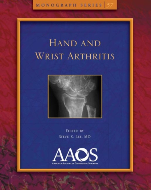 Hand and Wrist Arthritis, Paperback / softback Book