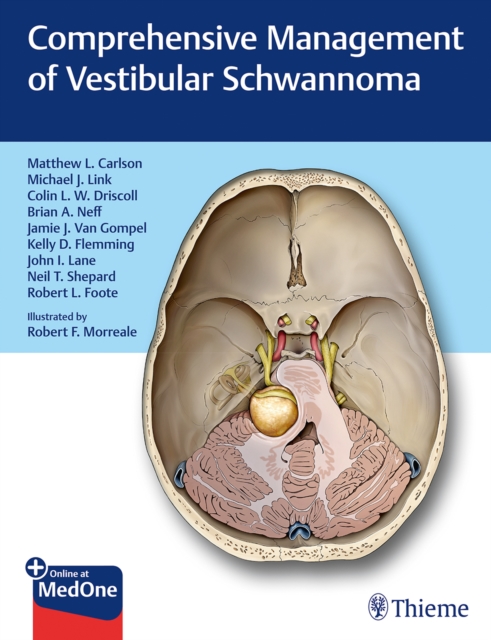 Comprehensive Management of Vestibular Schwannoma, Mixed media product Book