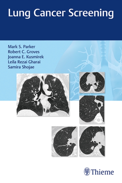 Lung Cancer Screening, Paperback / softback Book