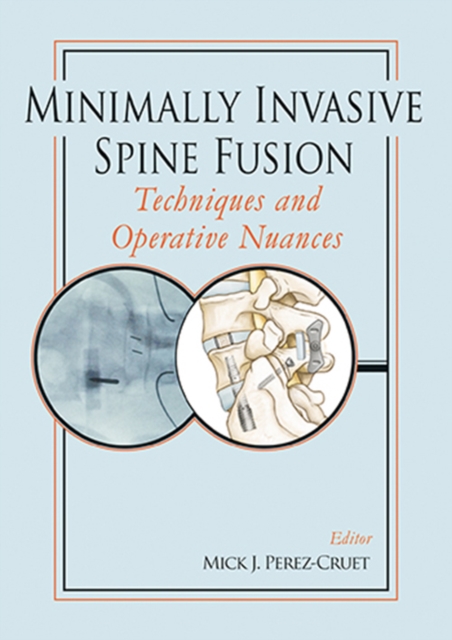 Minimally Invasive Spine Fusion: Techniques and Operative Nuances, Hardback Book