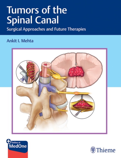 Tumors of the Spinal Canal : Surgical Approaches and Future Therapies, Multiple-component retail product, part(s) enclose Book