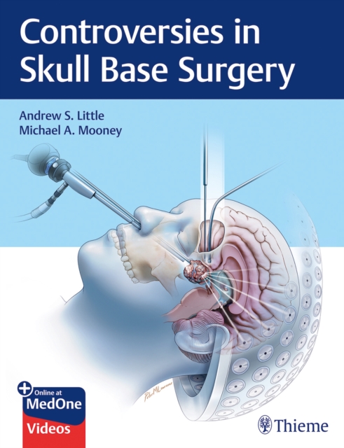 Controversies in Skull Base Surgery, Mixed media product Book