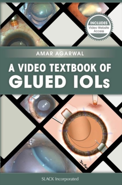 A Video Textbook of Glued IOLs, Paperback / softback Book