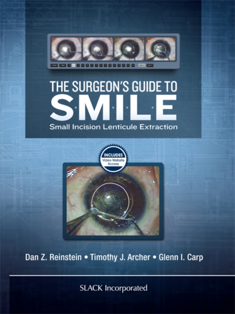 The Surgeon's Guide to SMILE : Small Incision Lenticule Extraction, PDF eBook