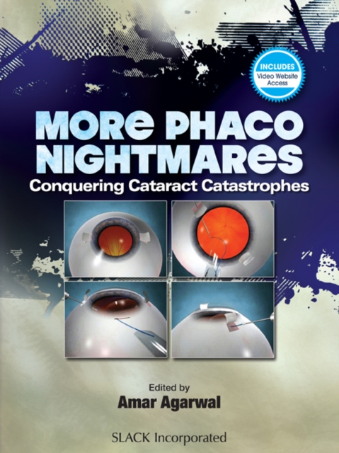 More Phacoo Nightmares : Conquering Cataract Catastrophes, PDF eBook
