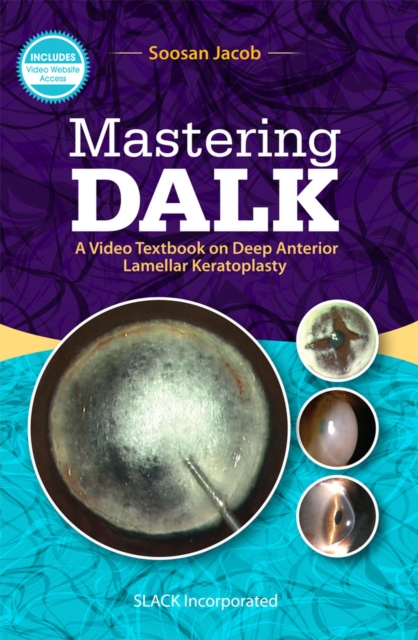 Mastering DALK : A Video Textbook on Deep Anterior Lamellar Keratoplasty, Paperback / softback Book
