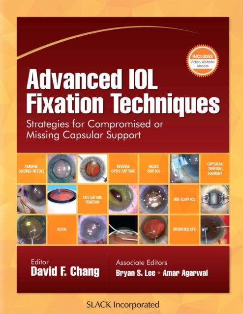 Advanced IOL Fixation Techniques : Strategies for Compromised or Missing Capsular Support, Hardback Book