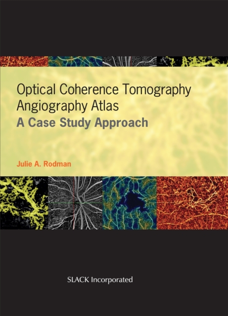 Optical Coherence Tomography Angiography Atlas : A Case Study Approach, Hardback Book