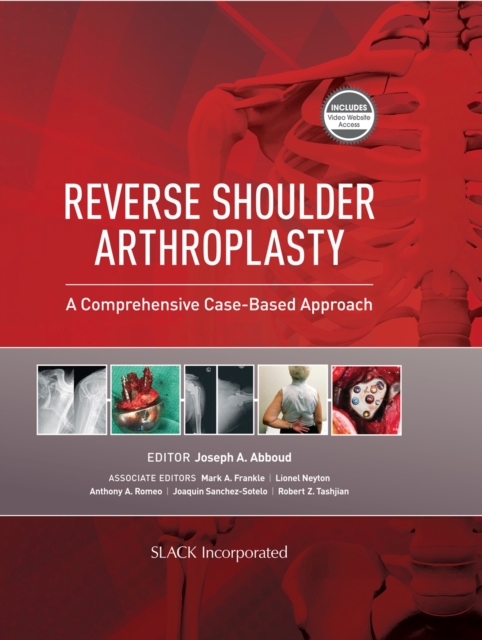 Reverse Shoulder Arthroplasty : A Comprehensive Case-Based Approach, Hardback Book