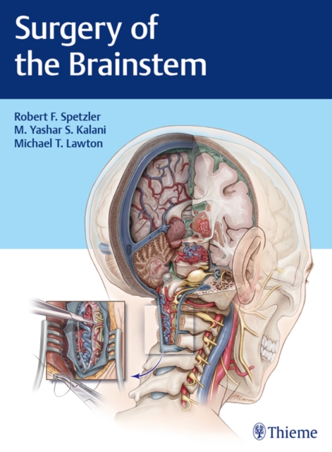 Surgery of the Brainstem, EPUB eBook