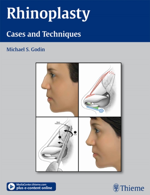 Rhinoplasty : Cases and Techniques, EPUB eBook