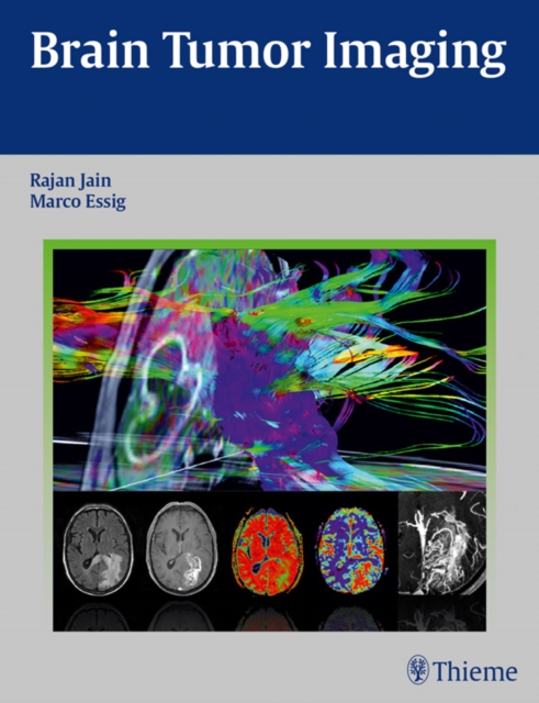 Brain Tumor Imaging, EPUB eBook
