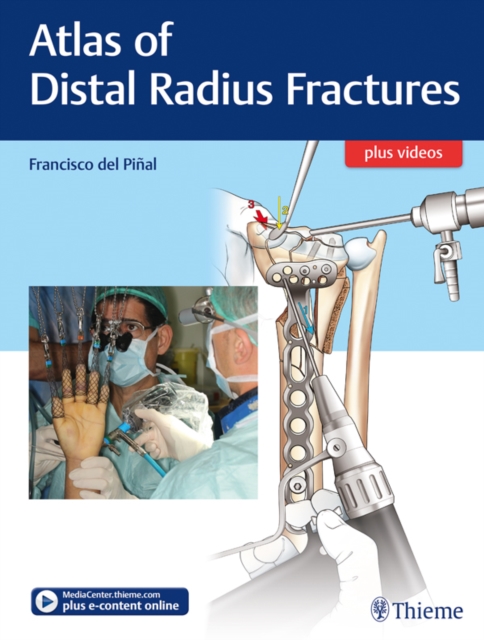 Atlas of Distal Radius Fractures, EPUB eBook