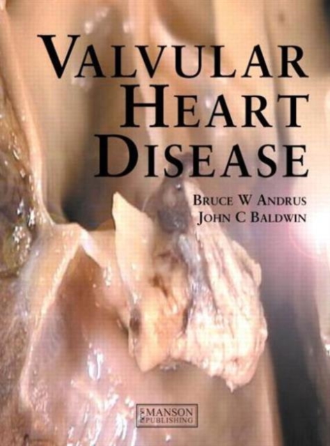 Valvular Heart Disease, Hardback Book