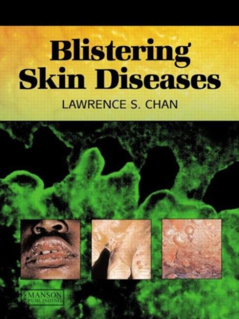 Blistering Skin Diseases, Hardback Book