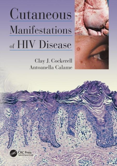 Cutaneous Manifestations of HIV Disease, Hardback Book
