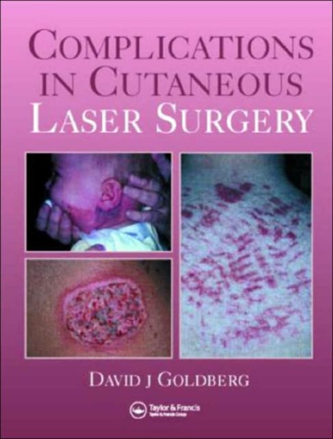 Complications in Laser Cutaneous Surgery, Hardback Book