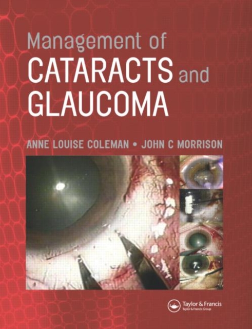 Management of Cataracts and Glaucoma, Hardback Book