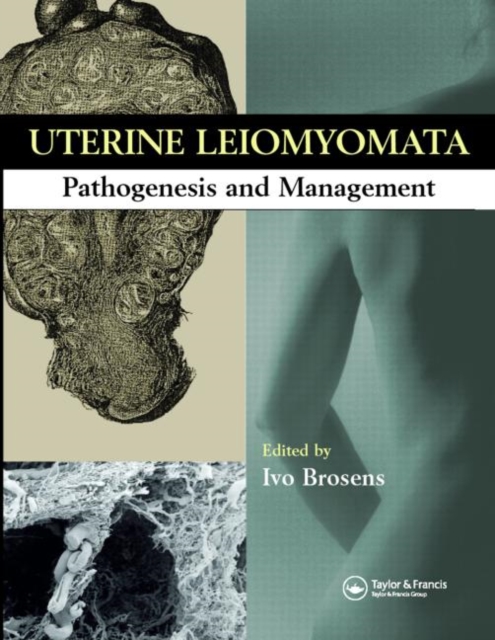 Uterine Leiomyomas : Pathogenesis and Management, Hardback Book
