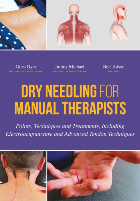Dry Needling for Manual Therapists : Points, Techniques and Treatments, Including Electroacupuncture and Advanced Tendon Techniques, Hardback Book