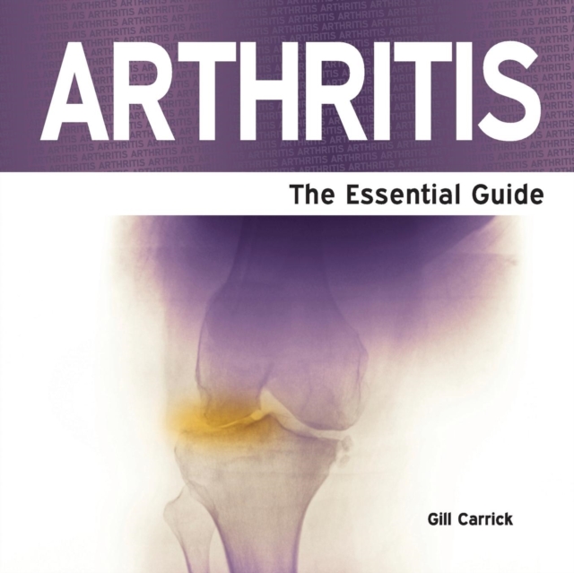 Arthritis : The Essential Guide, Paperback Book