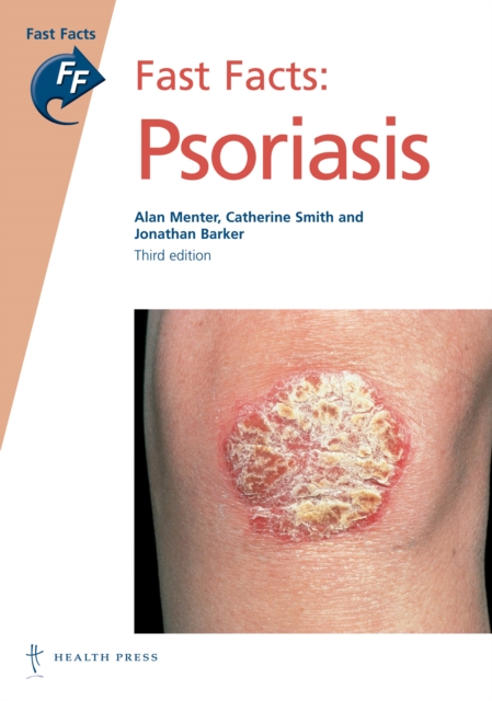 Fast Facts: Psoriasis, Paperback Book