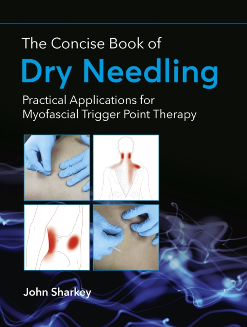 The Concise Book of Dry Needling : A Practitioner's Guide to Myofascial Trigger Point Applications, Paperback / softback Book