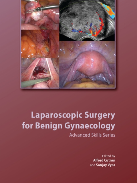 Laparoscopic Surgery for Benign Gynaecology Hardback with DVDs, Multiple-component retail product Book