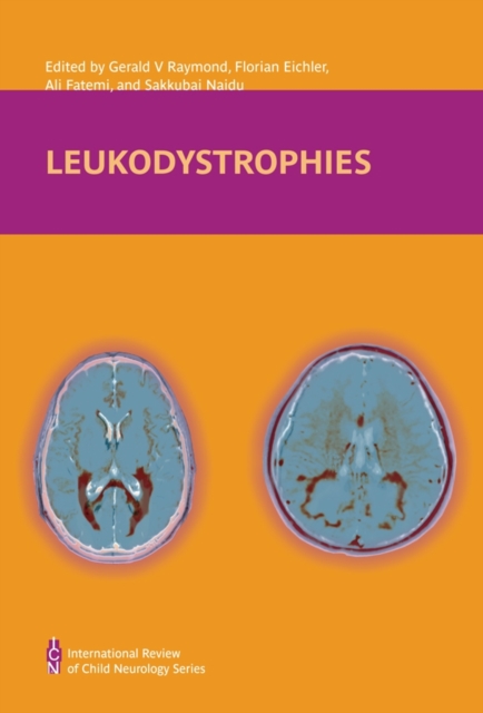 Leukodystrophies, PDF eBook