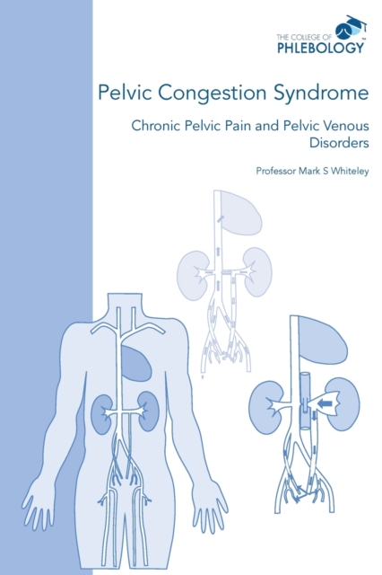 Pelvic Congestion Syndrome - Chronic Pelvic Pain and Pelvic Venous Disorders, Paperback / softback Book