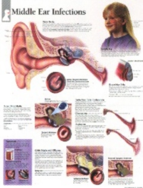 Middle Ear Infections Paper Poster, Poster Book