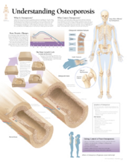 Understanding Osteoporosis Laminated Poster, Poster Book