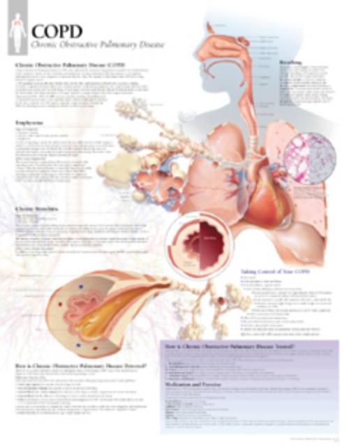 COPD (Chronic Obstructive Pulmonary Disease) Laminated Poster, Poster Book