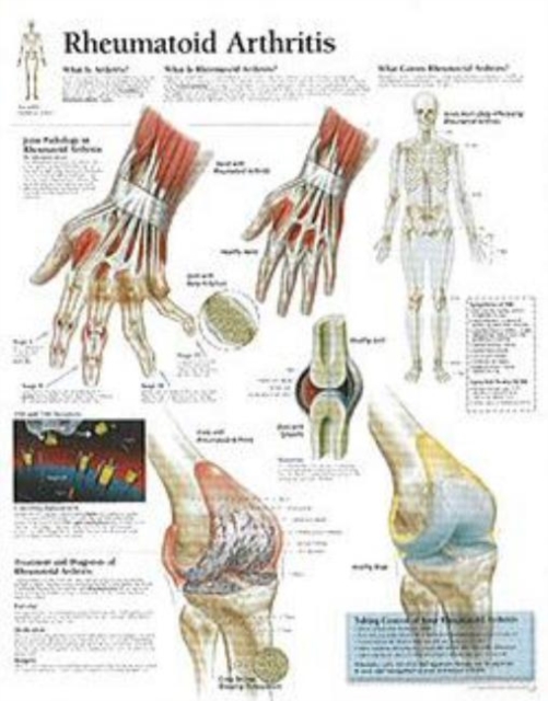Rheumatoid Arthritis Paper Poster, Poster Book