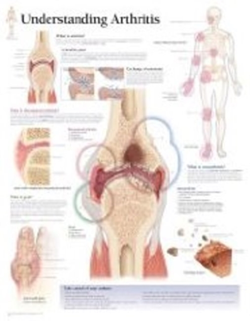 Understanding Arthritis Paper Poster, Poster Book