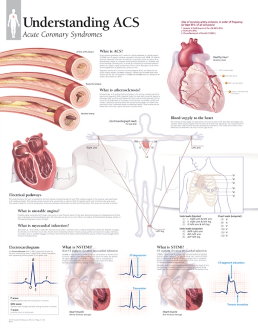 Understanding ACS (Acute Coronary Syndrome) Paper Poster, Poster Book