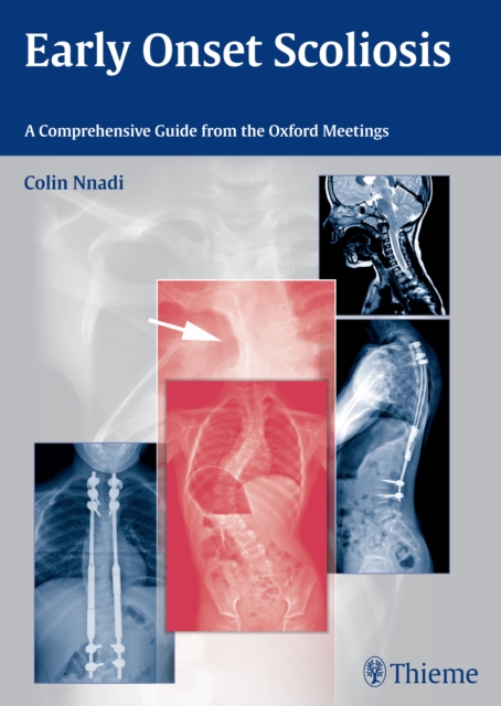 Early Onset Scoliosis : A Comprehensive Guide from the Oxford Meetings, Hardback Book